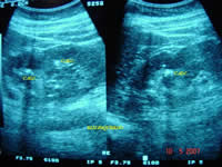 Calculo Renal